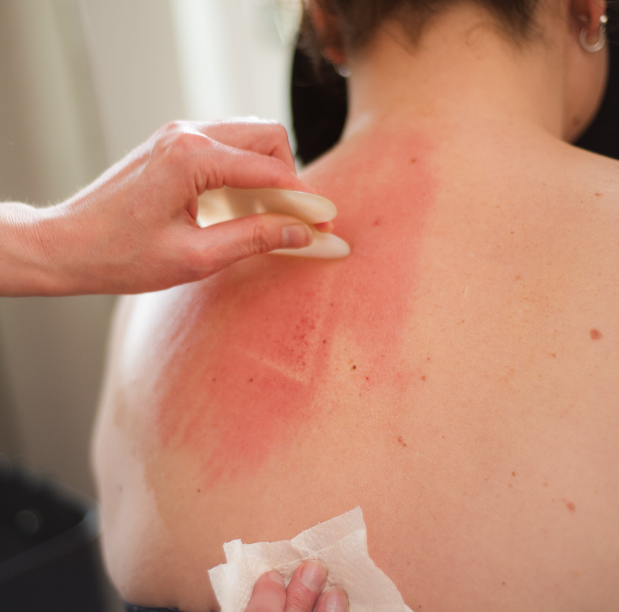 Guasha therapie bij Revavita in Eerbeek